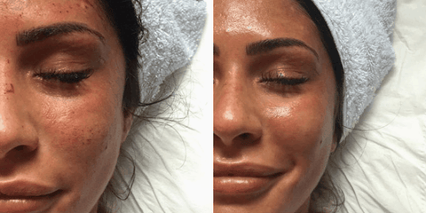 LED Light treatment post-microneedling