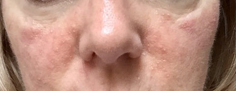 Rosacea. Papules and pustules and inflammation around the eyes