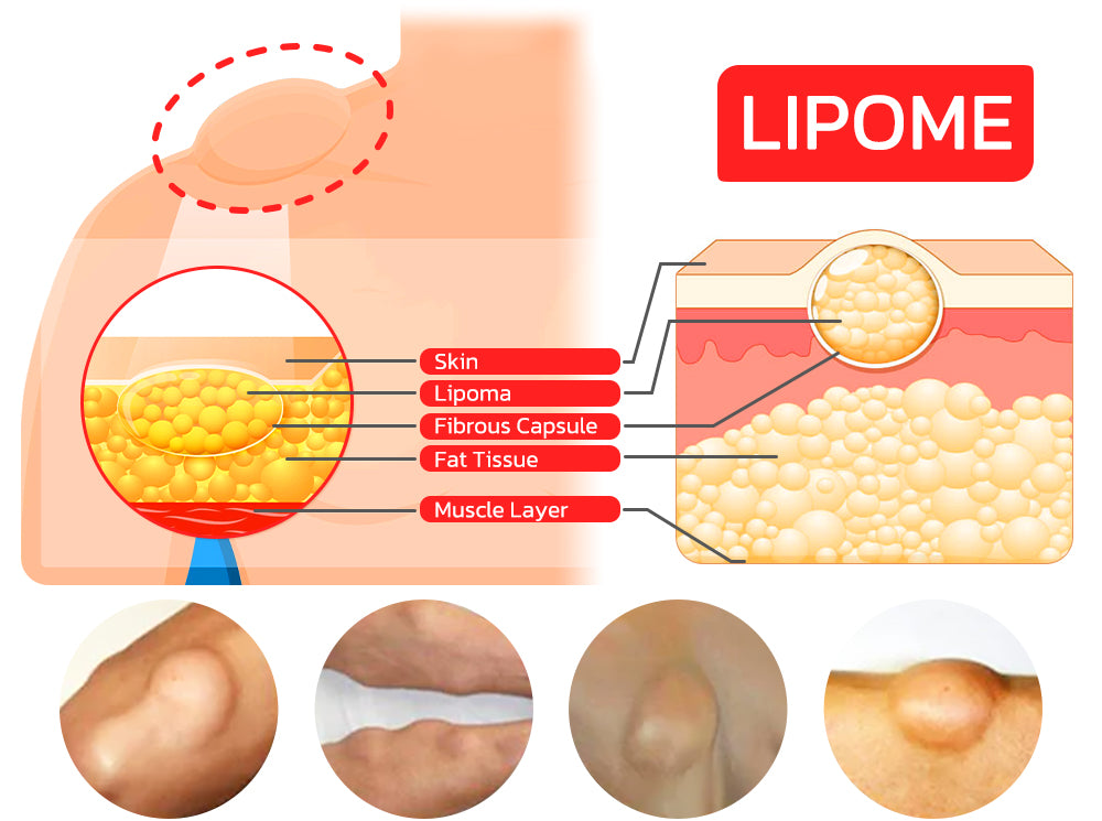 GFOUK™ Lumpless Lipom-Behandlungscreme