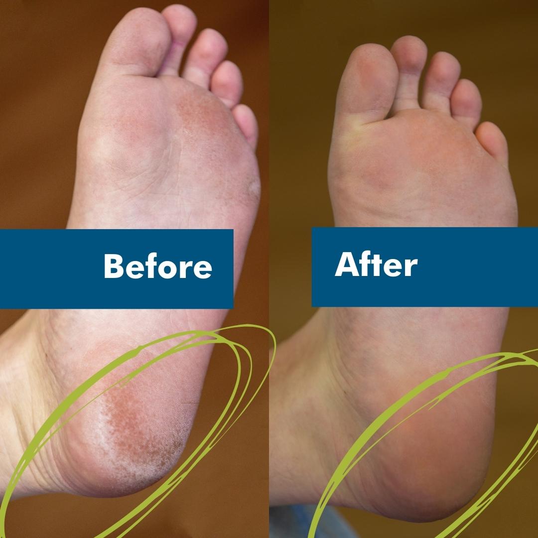 Foot care before and after