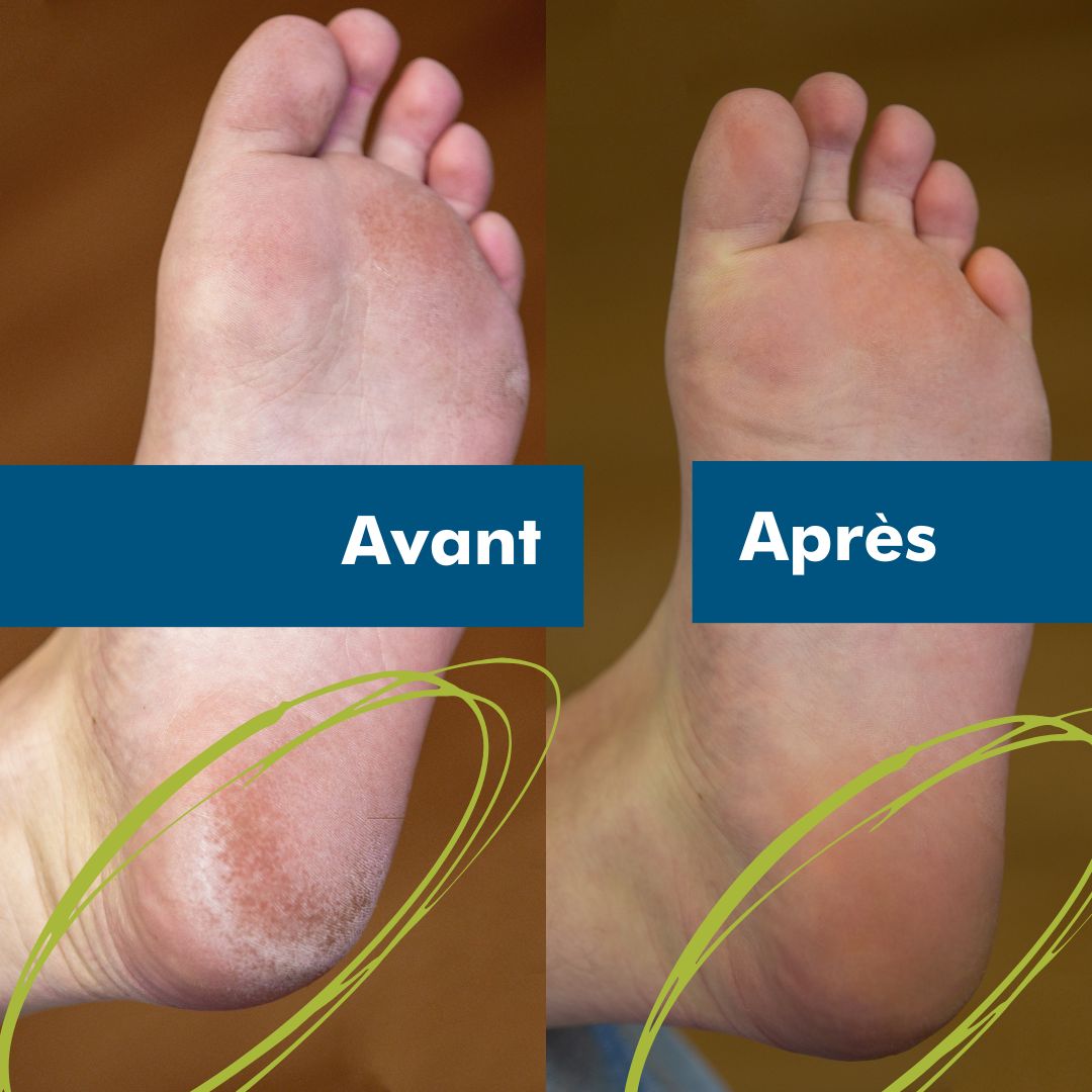 Soins des pieds avant et après