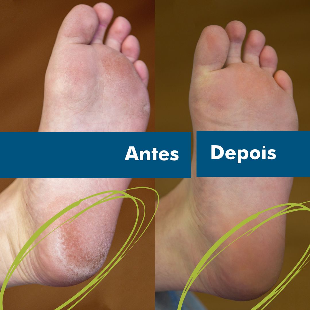 Cuidados com os pés antes e depois