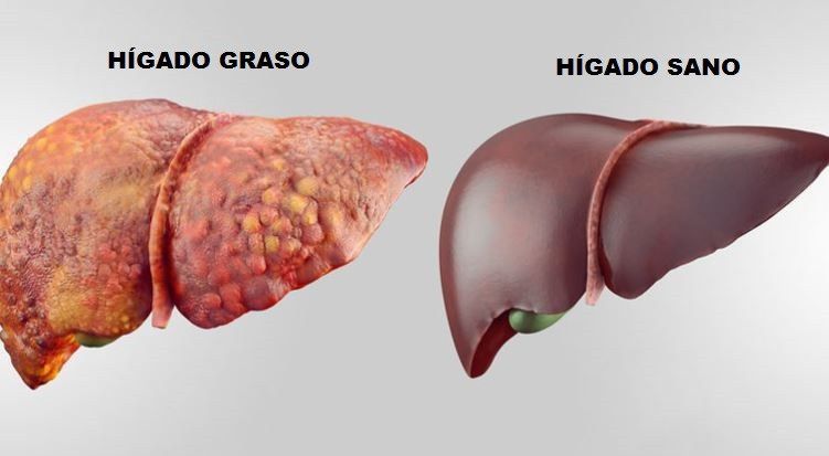 Limpia tu higado de forma natural con alcachofa