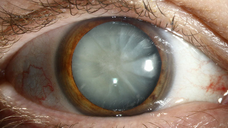Eye With Cataracts