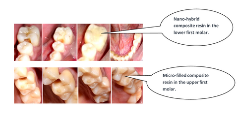 blog-dental-composite-nanofill-microfill