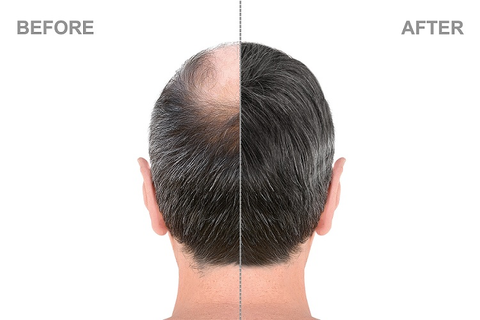 hair transplant benefits