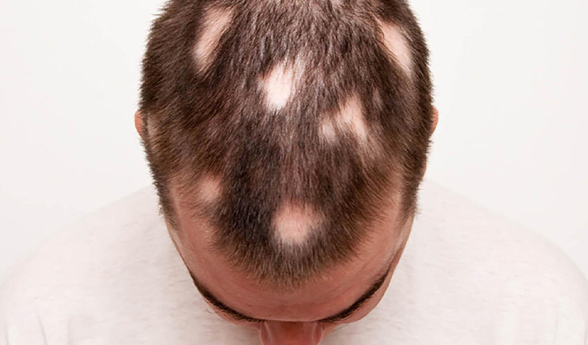 A man is currently struggling with the effects of Alopecia Areata