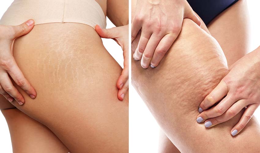 A picture comparing cellulite and stretch marks.