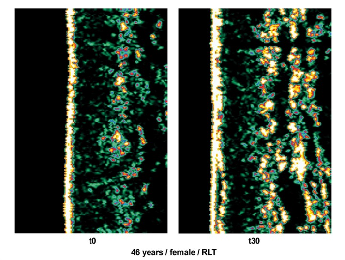 Comparison of collagen before and after RLT.