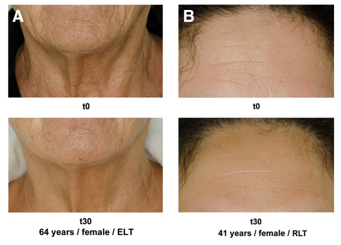 Comparison of skin condition before and after RLT.