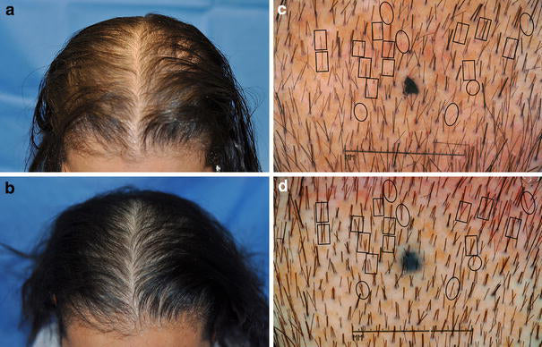 One picture demonstrating the before and after hair growth effects of red light therapy.