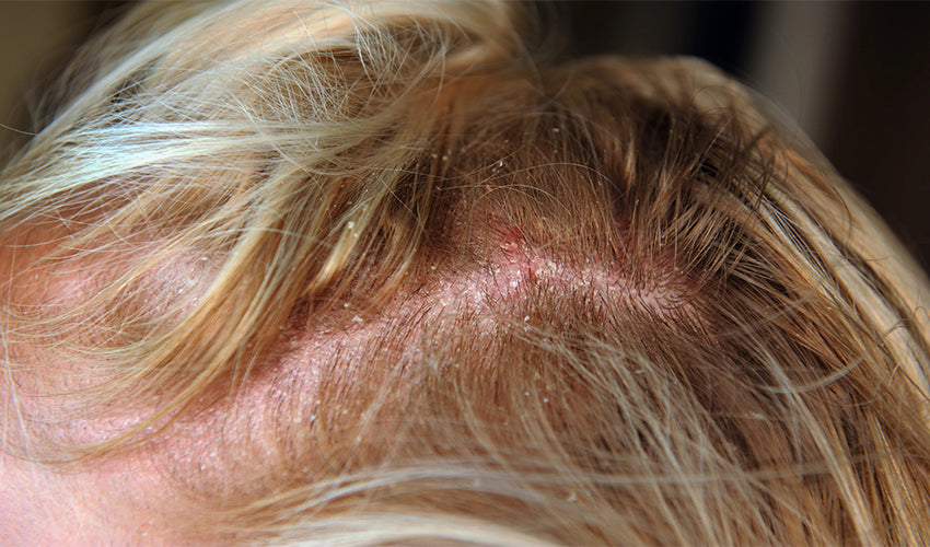 A woman is currently suffering from scalp infection, inflammation, and hair loss.