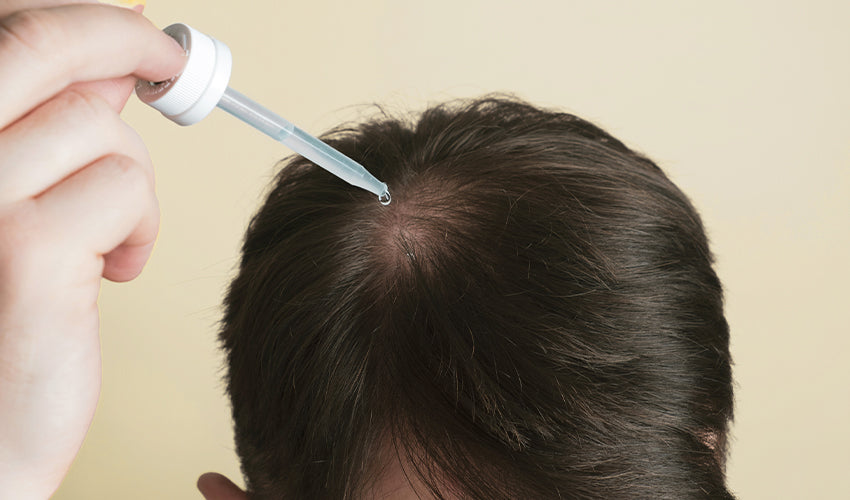 A man is using medication to stimulate hair growth