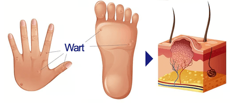 WartFREE™ Common & Plantar Wart Remover