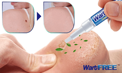 WartFREE™ Common & Plantar Wart Remover
