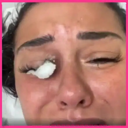 women with an allergic reaction to an infection caused by lash glue
