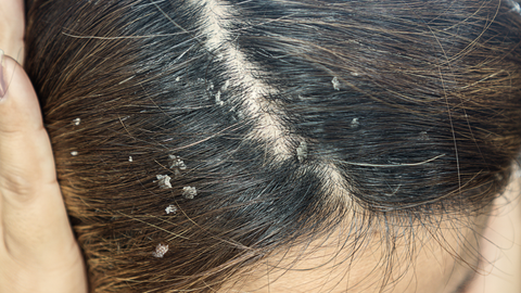 This is a closeup image of a scalp covered in dandruff due to an oily scalp. The model is holding her brown hair against her head, and we are looking down towards her middle part. This image is used in the Ippodaro Natural Salon blog post titled, “If You Want Luxurious Hair, You CAN NOT Overlook an Oily Scalp”.