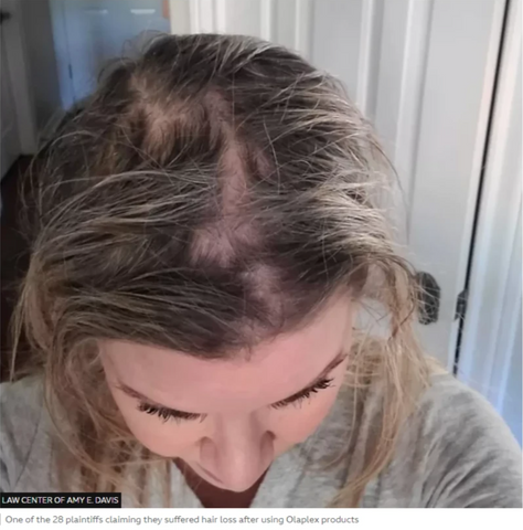 This image showcases one of the actual plaintiffs claiming that Olaplex has caused hair loss. This image is used in the Ippodaro Natural Salon blog post titled, "Olaplex.. Friend Or Enemy?"