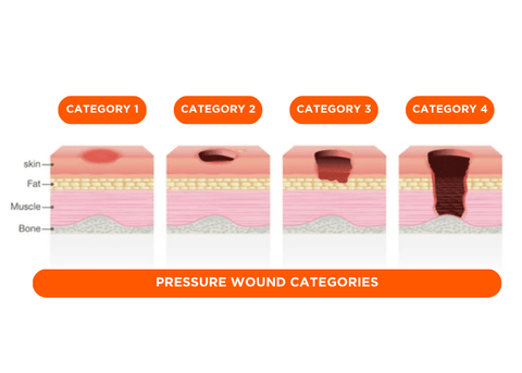 Pressure Ulcer Categorys