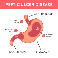 Peptic ulcer disease is a sore that develops on the lining of the esophagus, stomach, or small intestine.