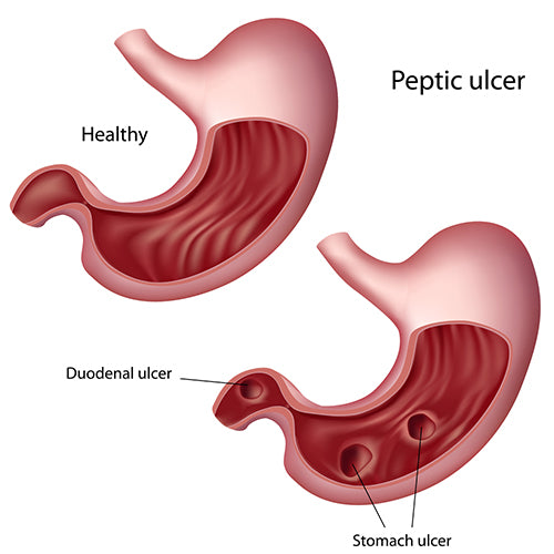 A duodenal ulcer is a sore that forms in the lining of the duodenum.