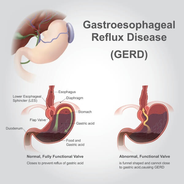 what-causes-acid-reflux-and-how-can-it-be-treated