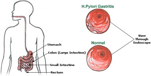 The H. pylori breath test is a simple and safe test used to detect an active H. pylori infection