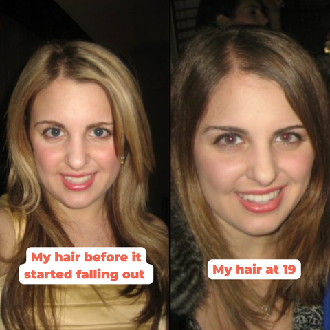 hair loss in my 20s