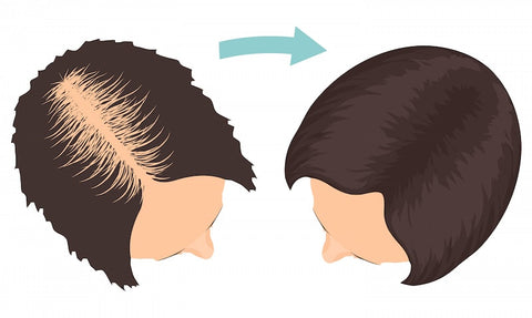 https://parsamohebi.com/hair-transplant/female-hair-transplant/