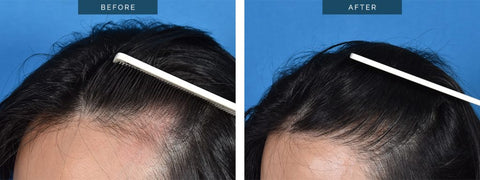 https://hairtransplantsmelbourne.com.au/female-hair-transplant-hairline-lowering/