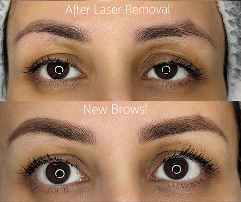 Ensure quality laser removal results which can see you then having your desired eyebrow treatment later