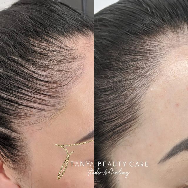 Why Korean Women Are Microblading Their Hairlines