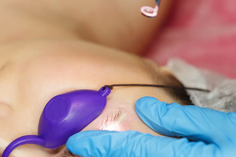 Tattoo removal treated area discolouration
