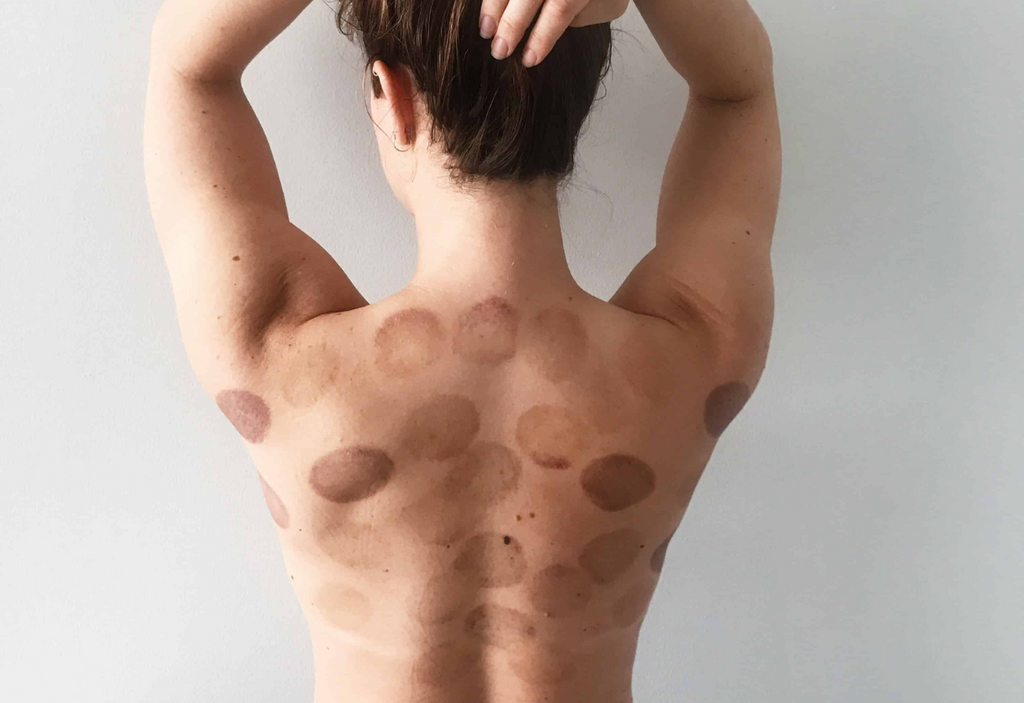 How cupping therapy affects mental health
