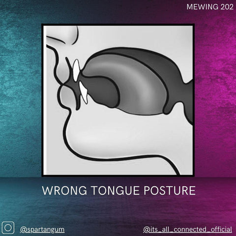 Wrong tongue posture