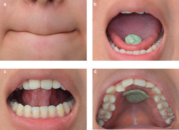 A person practicing tongue chewing and mewing