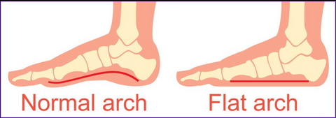 flat feet arches
