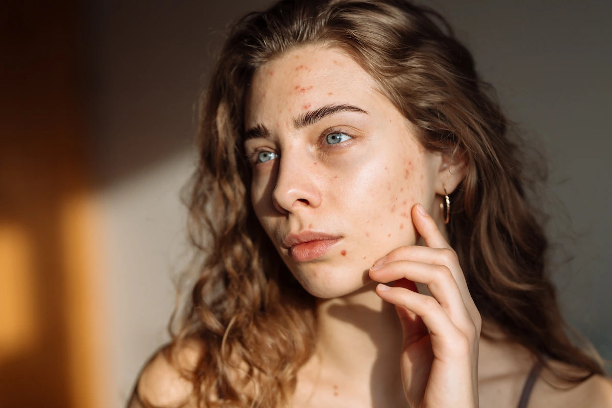 Young woman with acne-prone skin – ideal candidate for retinaldehyde treatment for sensitive or blemish-prone skin