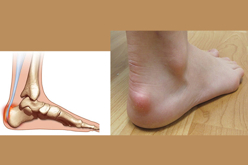 What Is Haglunds Deformity Happywalk Orthopedic And Diabetic Footwear Store 