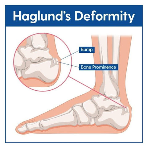Haglund's Deformity - The Frankel Foot & Ankle Center
