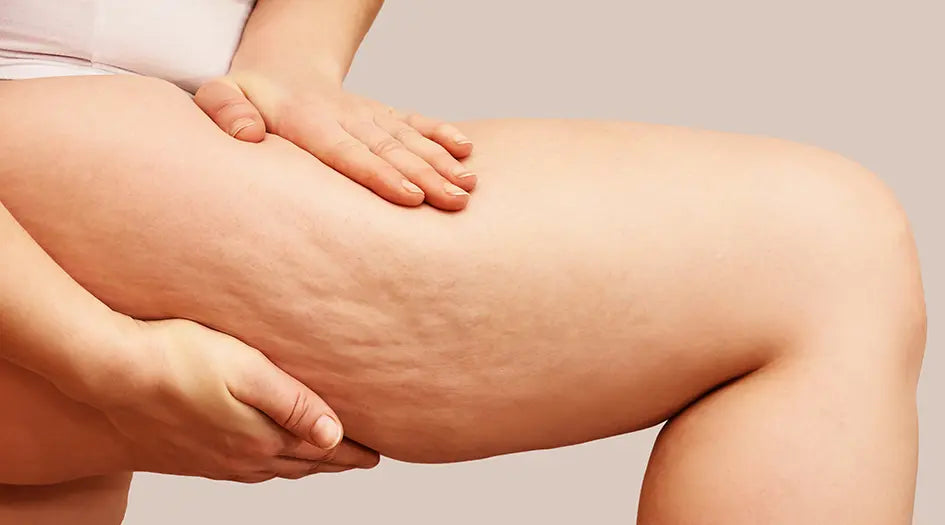 Frau bei der man die Cellulite am Oberschenkel sieht