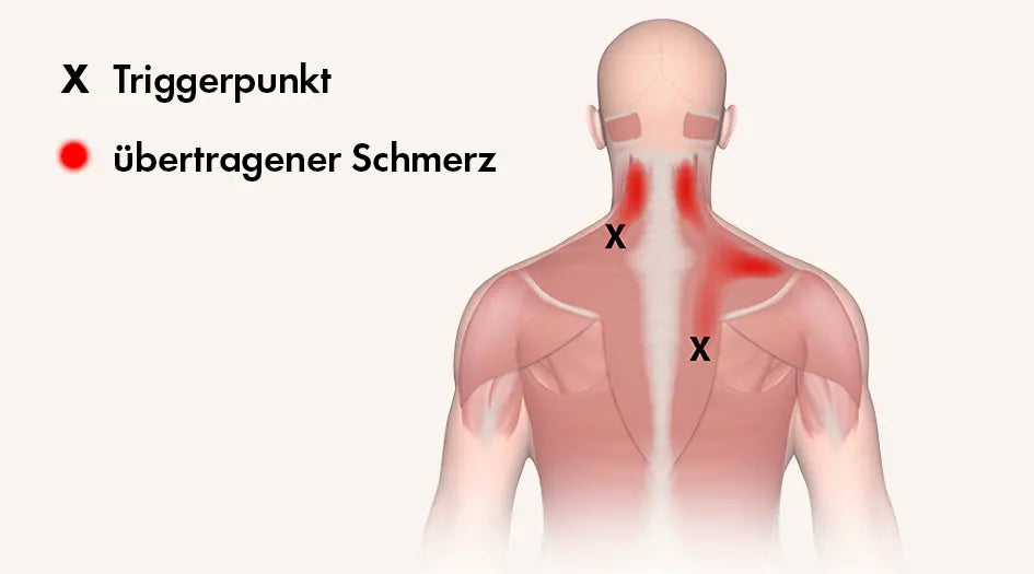 Visualisierung zeigt Lokalisation des Triggerpunkts und den dazugehörigen Schmerzbereich mit Ausstrahlungsschmerz