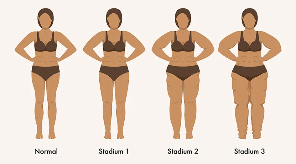 Grafik des Normalzustands und der drei Stadien des Lipödems