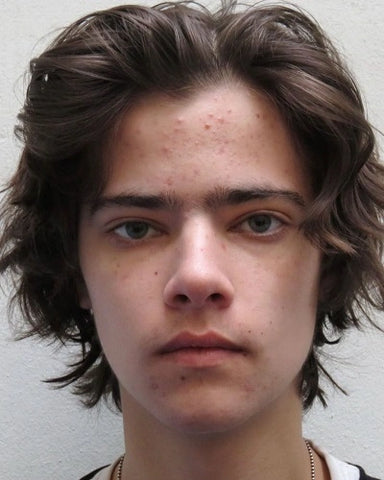 Acne Mechanica in Men