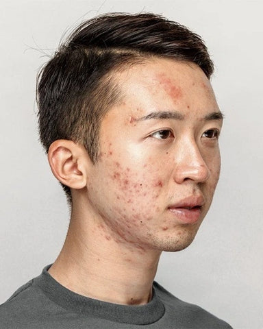 Inflammatory Acne in Men
