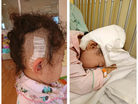 明凛ちゃんが３歳で右耳の人工内耳の手術をしたあとの写真
