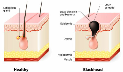 Healthy pore vs blackhead