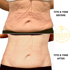 Before and after pictures of EvolveX TITE body sculpting treatment showing fatty and wrinkled skin on abs transformed into smoother and skinner ab section