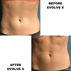 Before and after EvolveX Tone muscle strengthening and toning treatment showing abs with barely visible muscle definition to treated abs with more muscle definition and tone