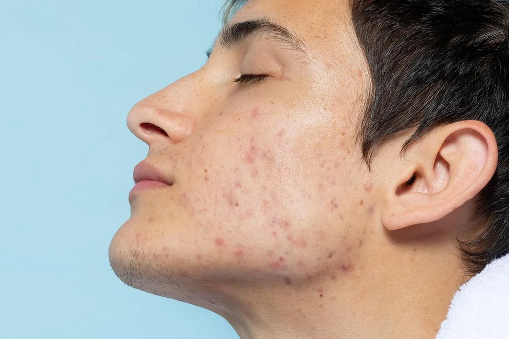 man with acne on face